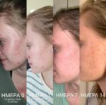 Bee Factor Κεραλοιφή για Ακμή & Σπυράκια 30ml - Image 6