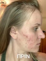 Bee Factor Κεραλοιφή για Ακμή & Σπυράκια 30ml - Image 7